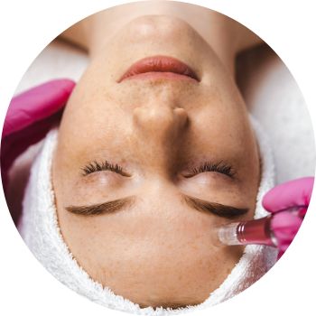 skin treatment - microdermabrasion
