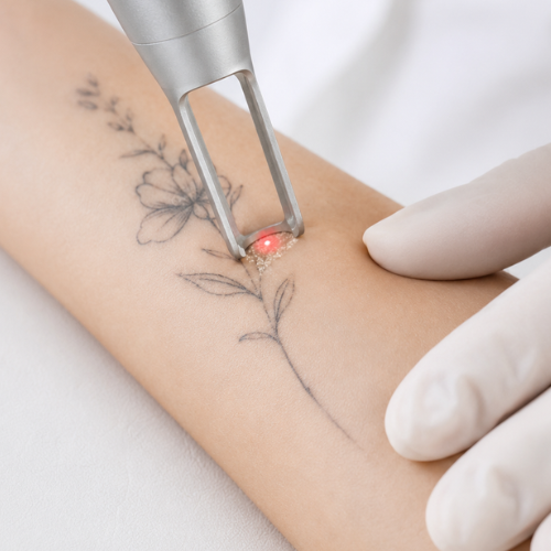 Tattoo removal 2