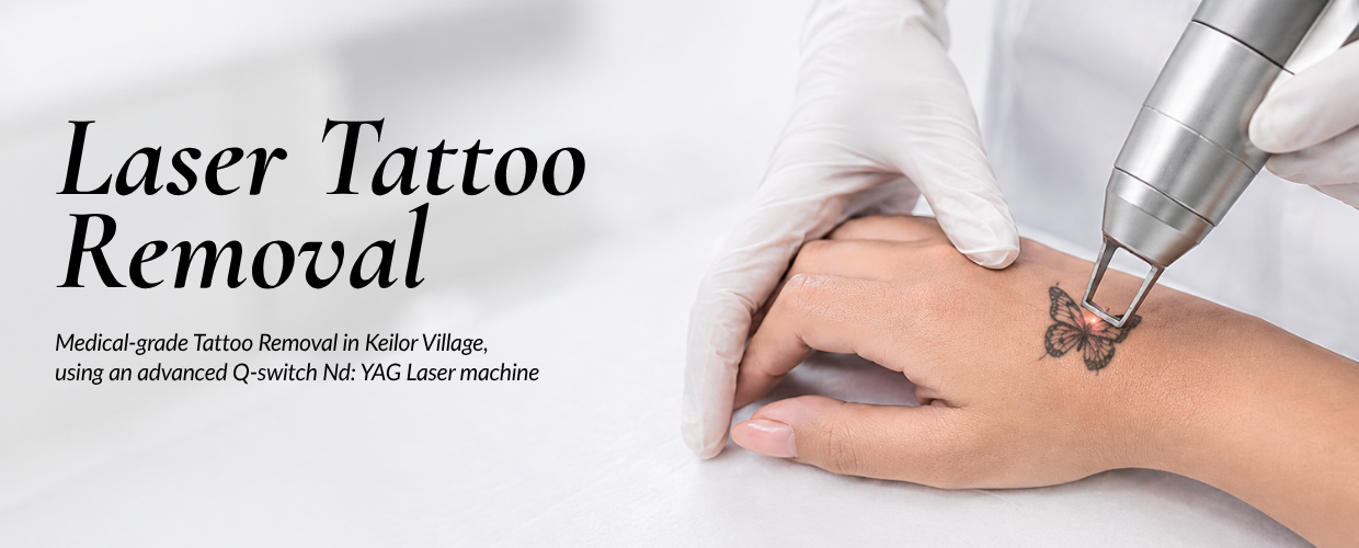 Tattoo removal Tattoo removal