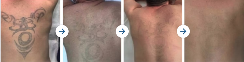 Tattoo_ Before and After Tattoo_ Before and After