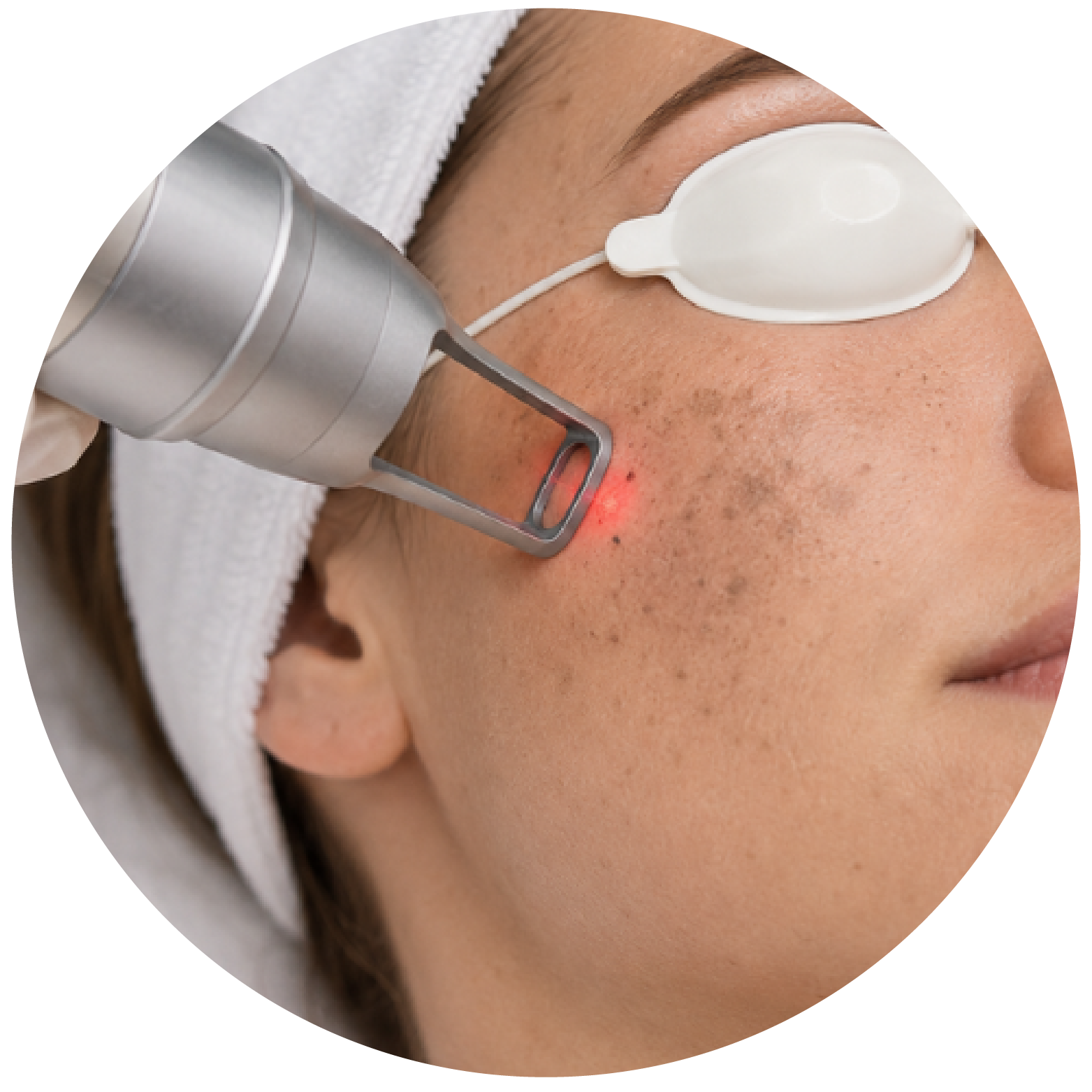 pigment removal