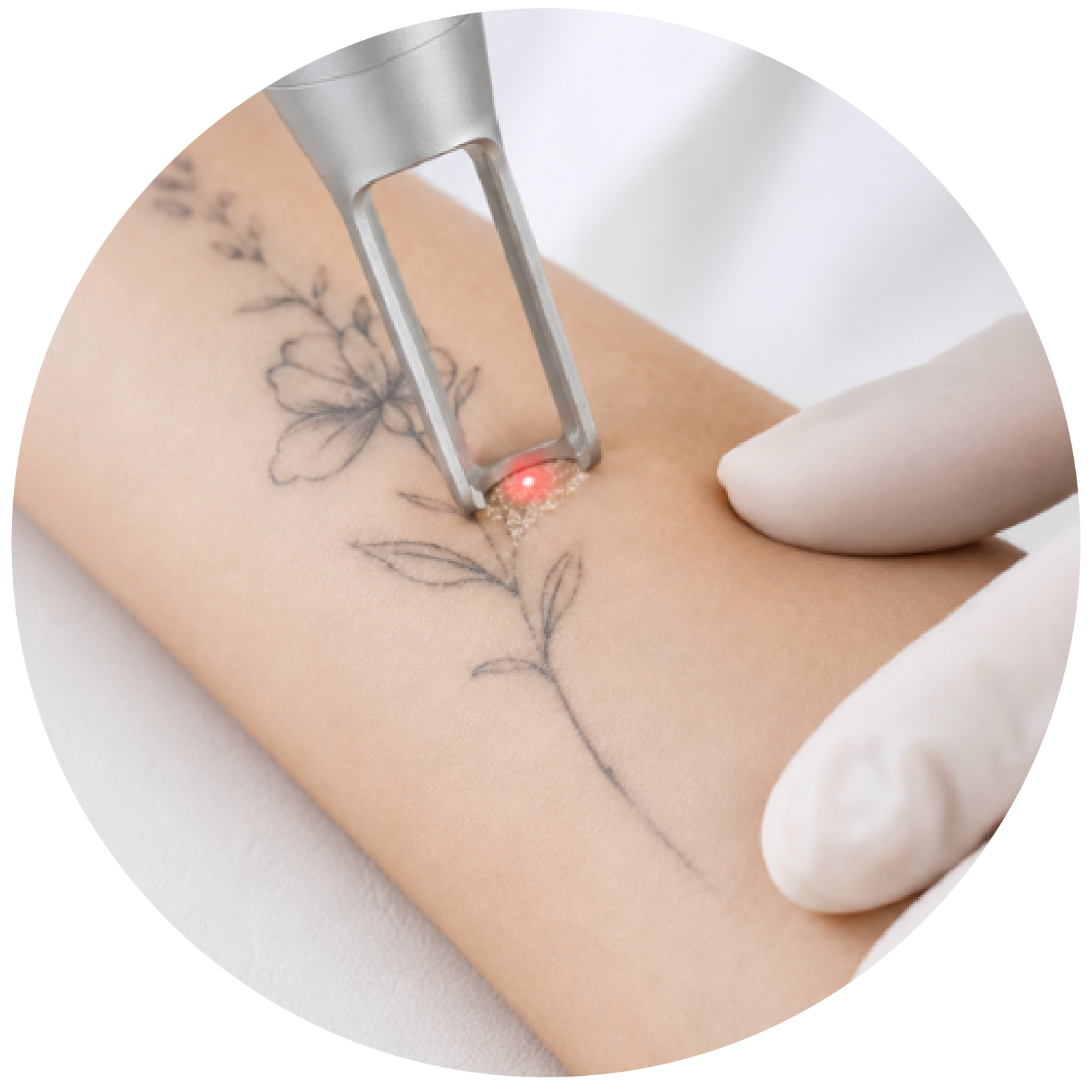 Tattoo removal