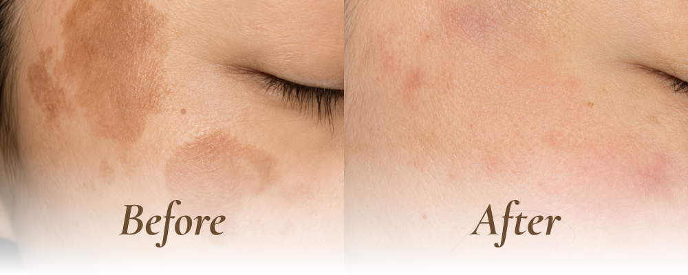 pigment removal before and after_1 pigment removal before and after