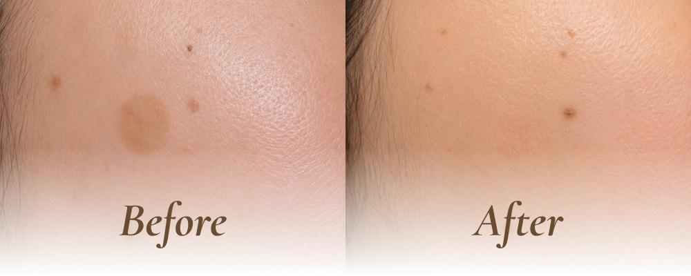 pigment removal before and after_2