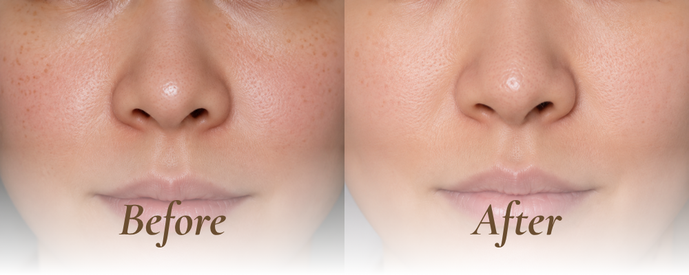 pigment removal before and after_3